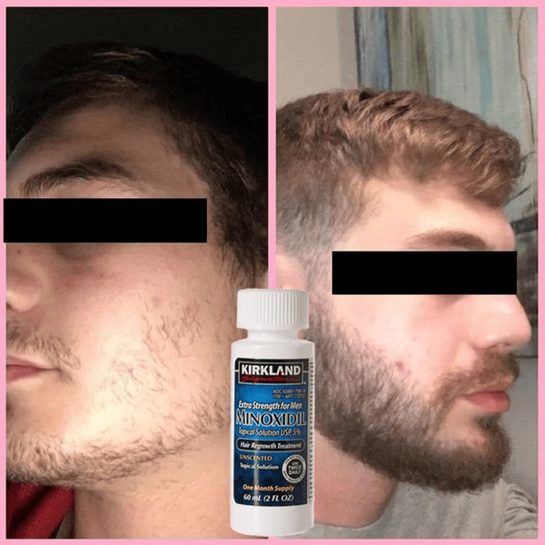 Лосьон minoxidil 5% KIRKLAND (6 флаконов) + дозатор 3 фото