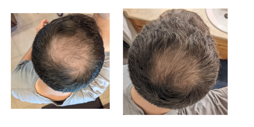 Пена minoxidil 5% KIRKLAND (1 флакон) 4 фото