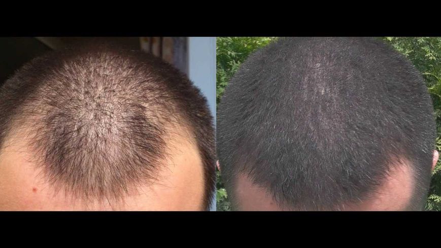 Пена minoxidil 5% KIRKLAND (1 флакон) 4 фото