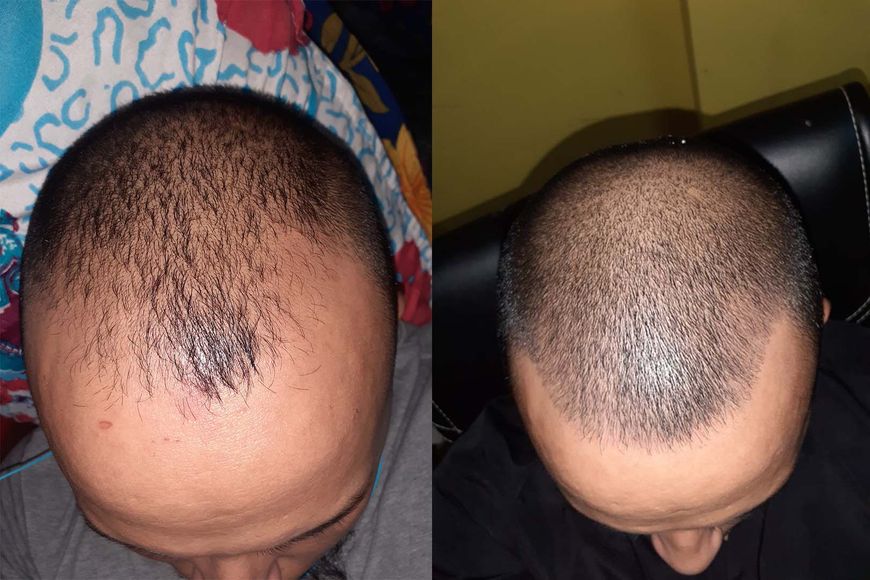 Піна minoxidil 5% KIRKLAND (2 флакони) 12 фото